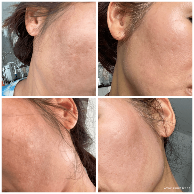 MELASMA Brown Spots Results Reviews MELINE Skincare Products sold in Canada - Lumilaser Esthetics, Montreal, Quebec.  Eve Mamane