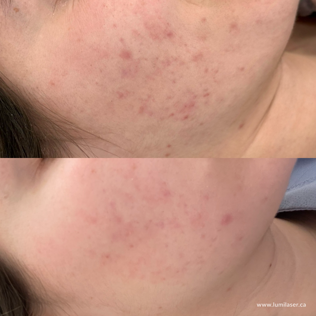 Results  Micro-Infusion, MicroChanneling Facial is offered at Lumilaser Esthetics located in Ville Saint-Laurent, Montreal, Quebec.