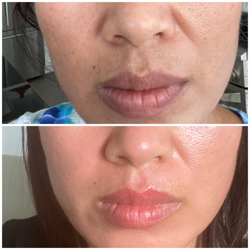 MELASMA Brown Spots Results Reviews MELINE Skincare Products sold in Canada - Lumilaser Esthetics, Montreal, Quebec.  Eve Mamane