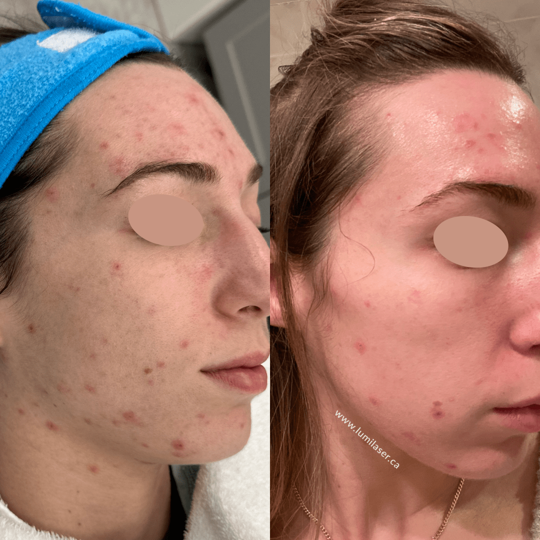 Acne Acne Scars Acne Laser Results in Montreal, Quebec, Canada, Lumilaser 