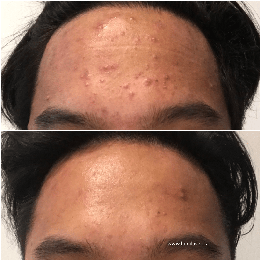 Acne Blemish Prone Skin Results Photos at Lumilaser Esthetics, Montreal, Quebec, Canada