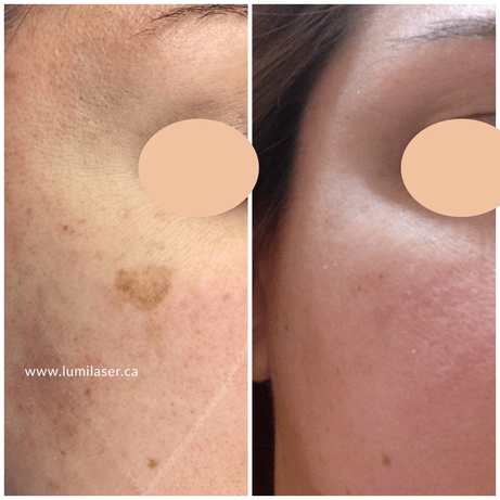 Removing brown spots with laser in Montrreal, Laser Sun Spots Removal