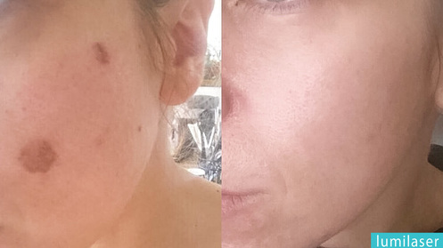 sun spots on face removal in montreal lumilaser