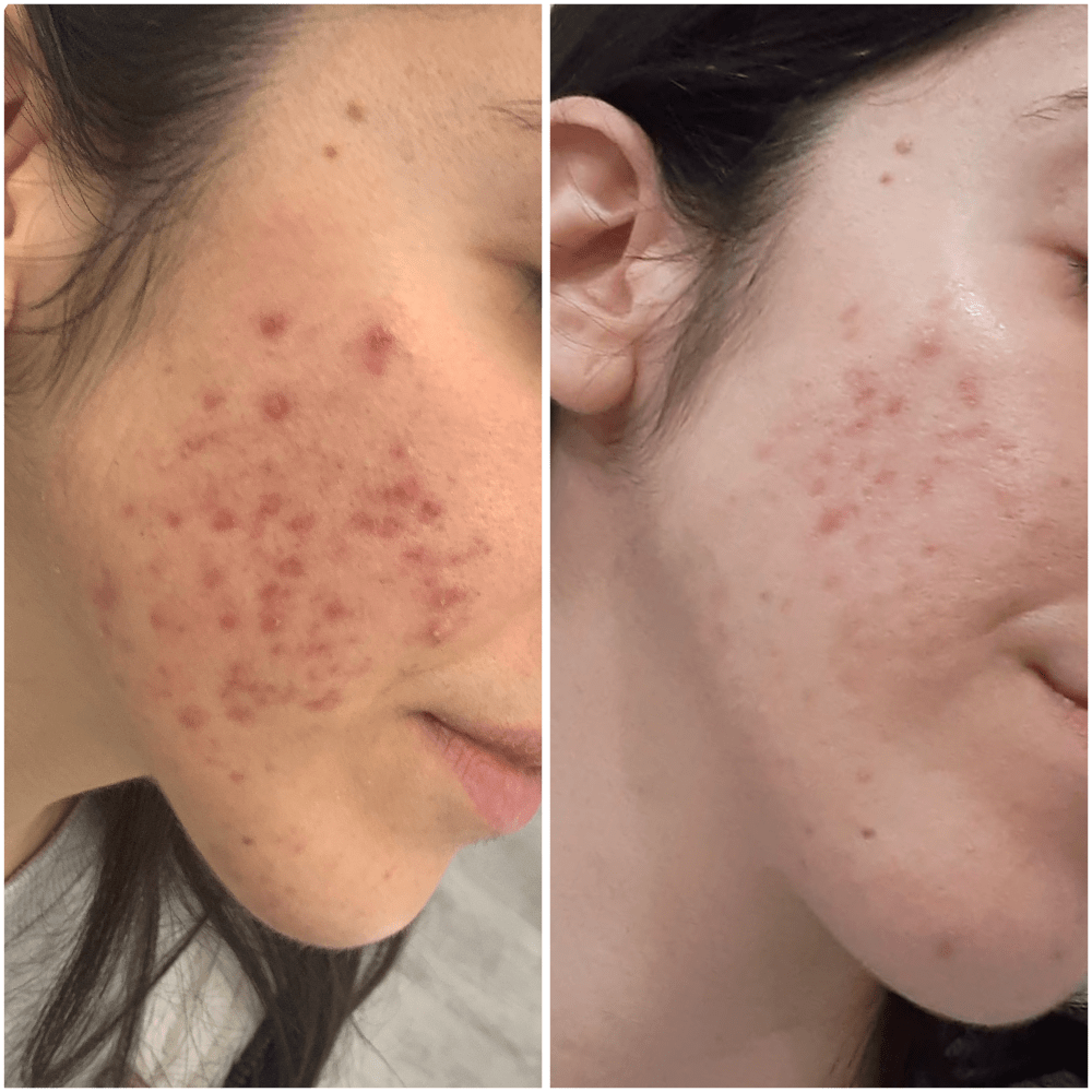 Acne and acne scars results Lumilaser, Montreal, Quebec, canada