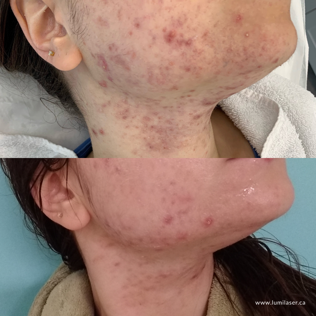 Acne Prone Skin Results - Progression - Lumilaser Esthetics - Montreal
