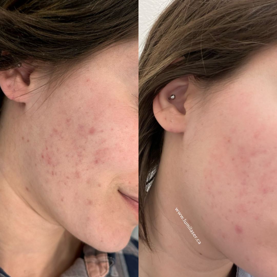 Results Micro Infusion, MicroChanneling, Dermal Stamping Facial in Montreal, Quebec, Canada