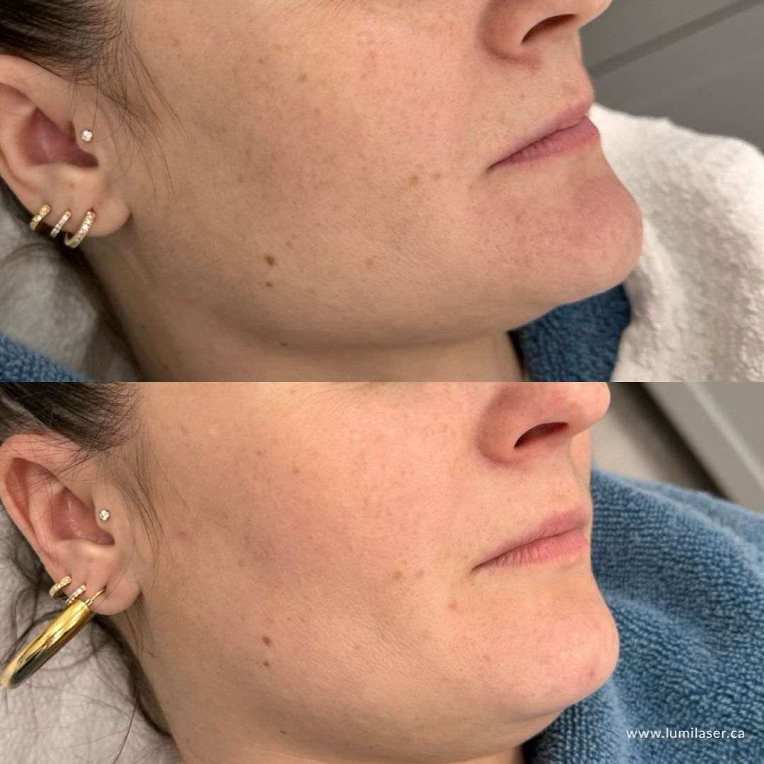 Results Micro Infusion, MicroChanneling, Dermal Stamping Facial in Montreal, Quebec, Canada