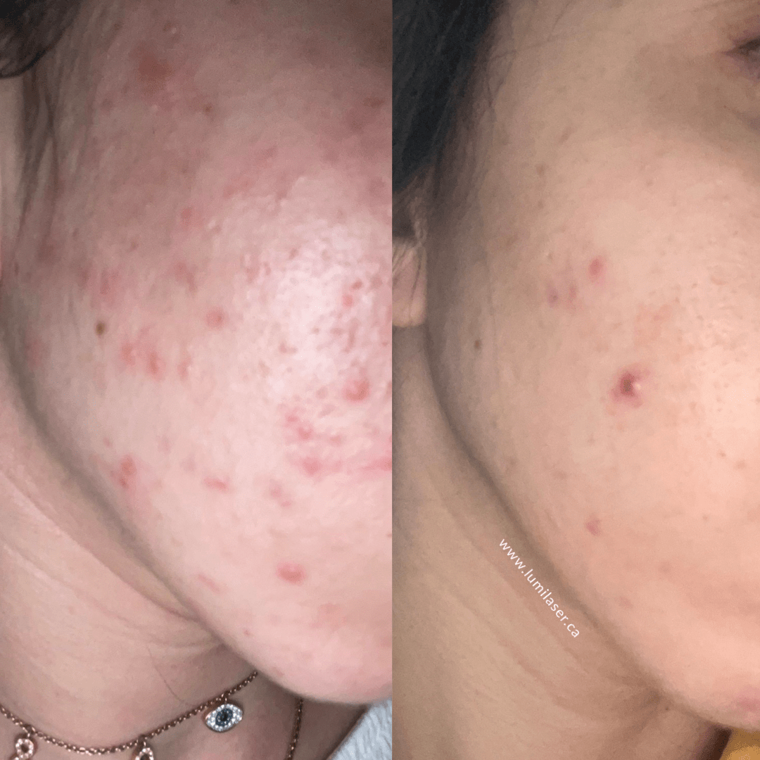 Acne & Acne Scars Treatments, Skincare Products & Results - Lumilaser - Montreal, Quebec