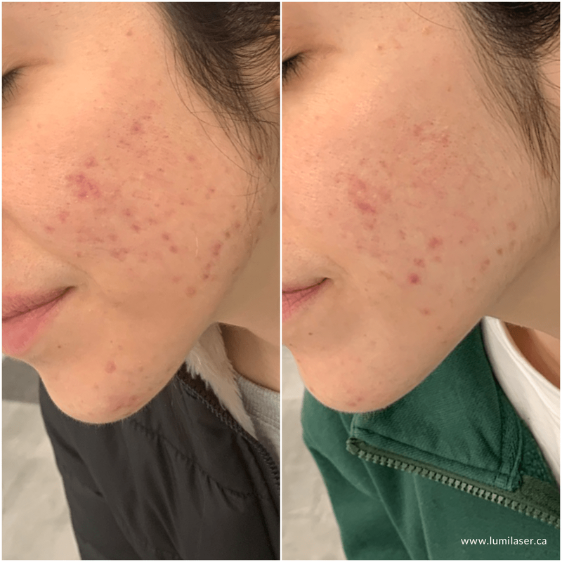 iS Clinical Skincare Products Pro-Health Serum Advanced+,  Canada, Montreal, Quebec, Acne, Acne Scars, Acne Marks Treatments in Montreal, Laval, Quebec, Canada at Lumilaser - Eve Mamane