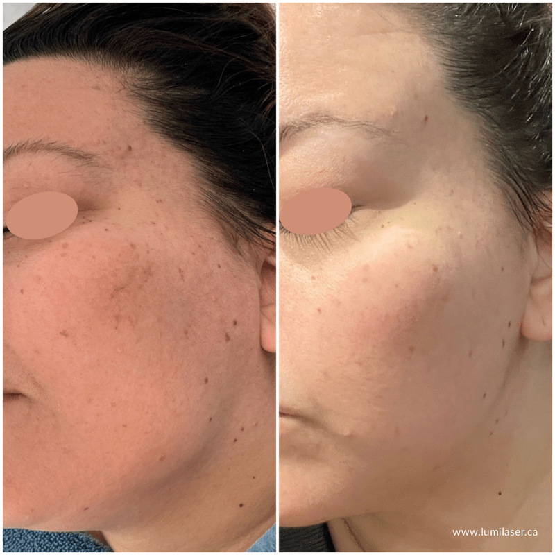 Laser Couperose, Rosacea, Treating Facial Redness with laser, Montreal, Quebec, Canada