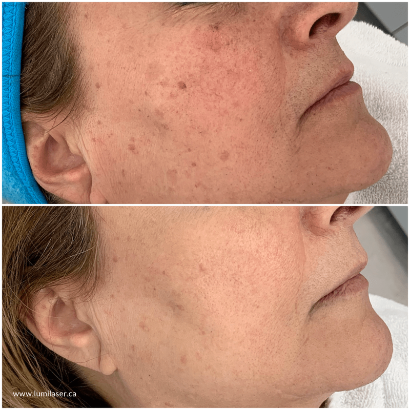 Laser Couperose, Rosacea, Treating Facial Redness with laser, Montreal, Quebec, Canada