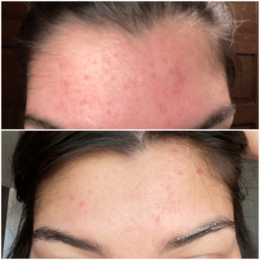 BEFORE AND AFTER PHOTOS AT LUMILASER ESTHETICS