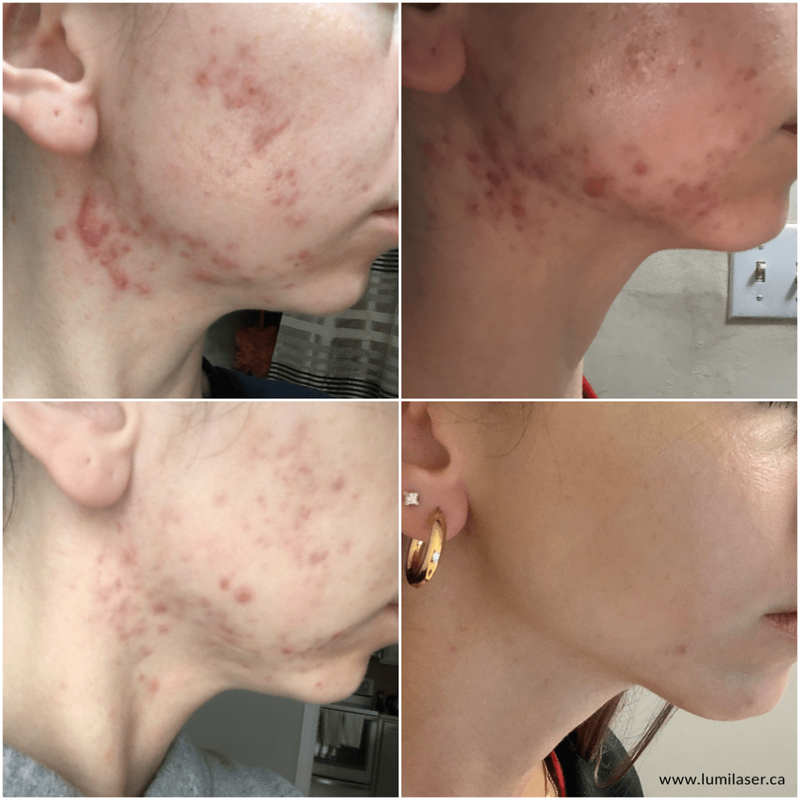 iS Clinical products in Canada, Montreal, Quebec, Acne, Acne Scars, Acne Marks treatments in Montreal, Laval, Quebec, Canada at Lumilaser - Eve Mamane