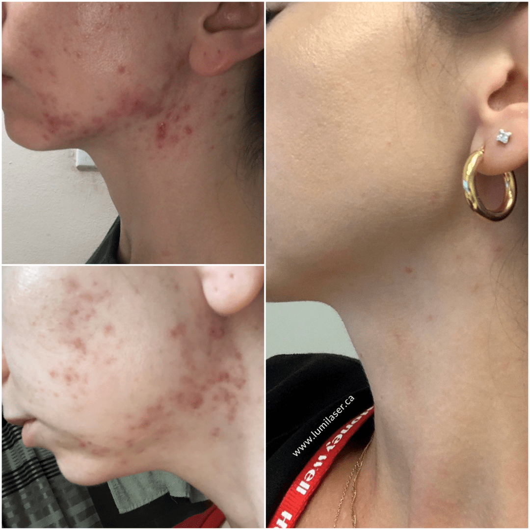 ACNE RESULTS - BEFORE & AFTER PHOTOS - LUMILASER