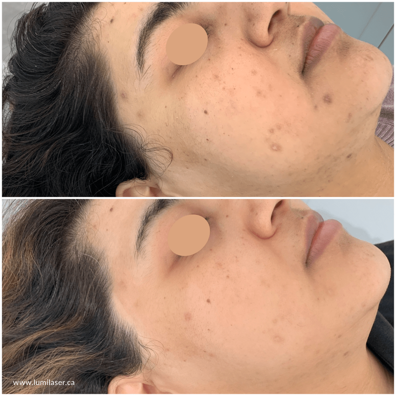 laser skin brightening acne scars in Montreal, skin brightening at Lumilaser Esthetics, Montreal, Quebec, Canada. Super Serum iS Clinical sold in Canada 