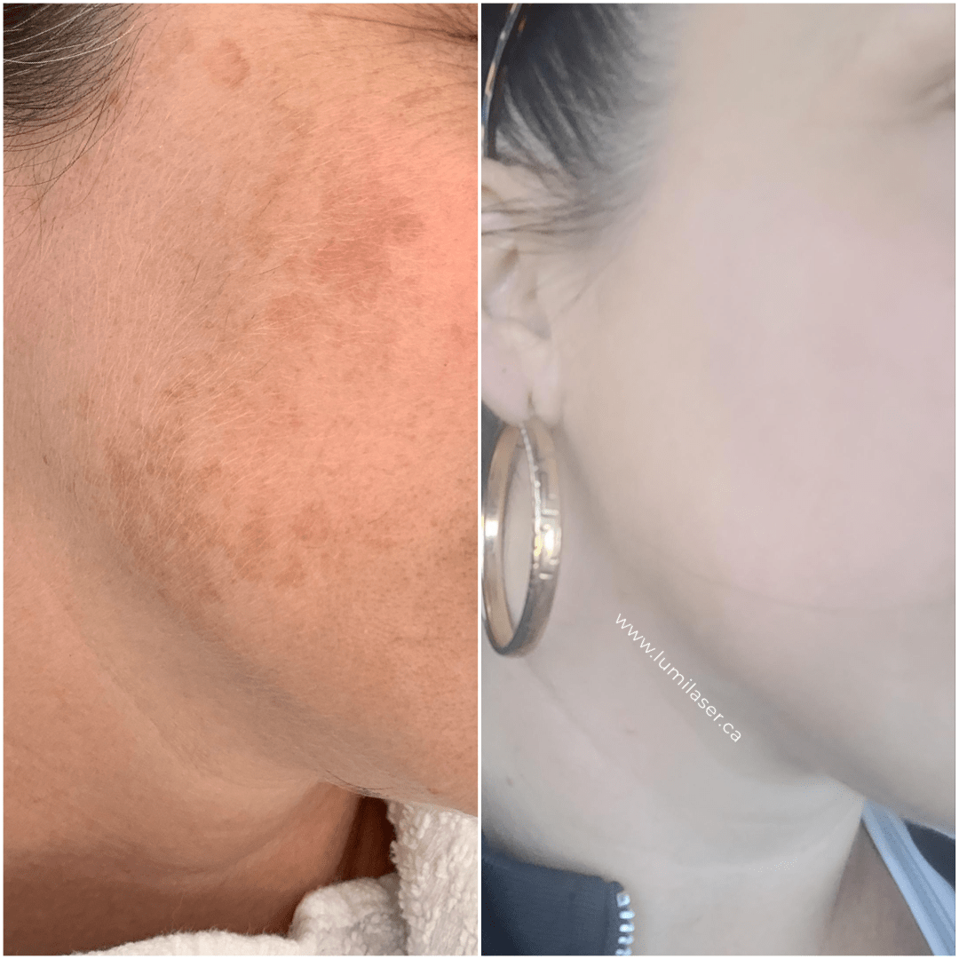 REMOVING BROWN SPOTS WITH LASER - LUMILASER MONTREAL 