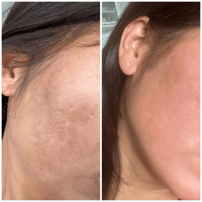 MELASMA Results Reviews MELINE Skincare Products sold in Canada - Lumilaser Esthetics, Montreal, Quebec.  Eve Mamane