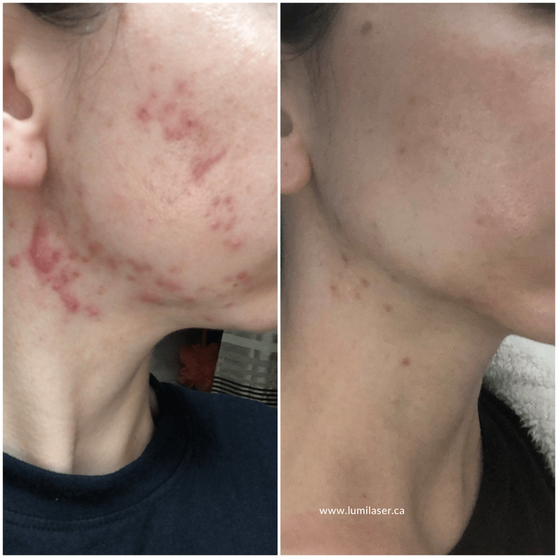 iS Clinical products in Canada, Montreal, Quebec, Acne, Acne Scars, Acne Marks treatments in Montreal, Laval, Quebec, Canada at Lumilaser