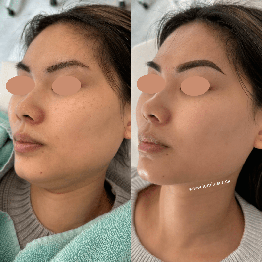 Beautiful Laser Skin Brightening and Brown Spots Results at Lumilaser Esthetics - Montreal, Quebec, Canada