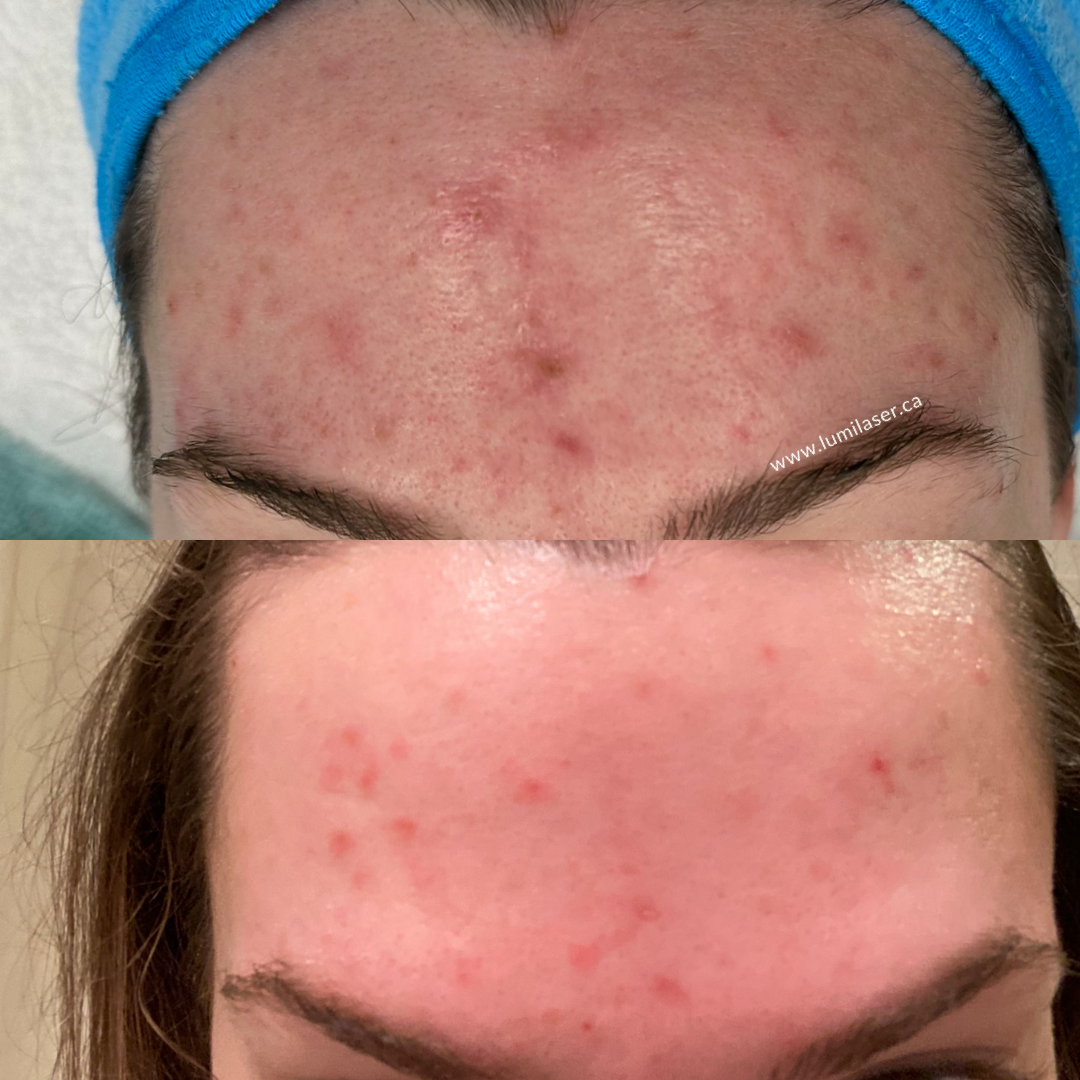 Acne Acne Scars Acne Laser Results in Montreal, Quebec, Canada, Lumilaser 