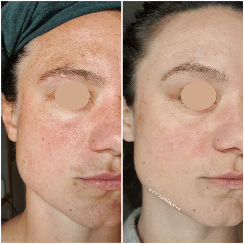 MELASMA Results Reviews MELINE Skincare Products sold in Canada - Lumilaser Esthetics, Montreal, Quebec.  Eve Mamane
