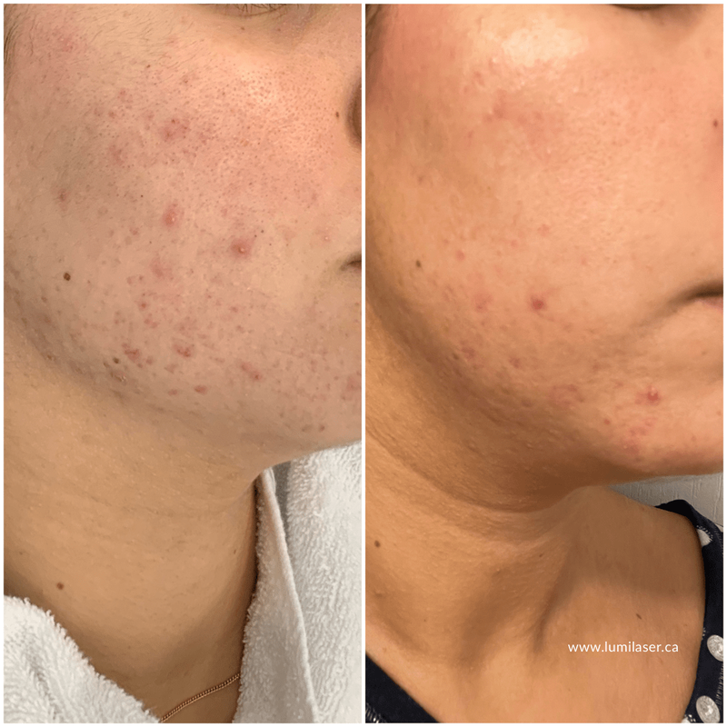 Laser Acne, Laser Acne Scars, Laser Acne Marks treatments in Montreal, Laval, Quebec, Canada at Lumilaser Esthetics by Eve Mamane, www.lumilaser.ca