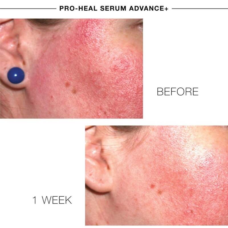 iS Clinical Skincare Products Pro-Health Serum Advanced+,  Canada, Montreal, Quebec, Acne, Acne Scars, Acne Marks Treatments in Montreal, Laval, Quebec, Canada at Lumilaser - Eve Mamane