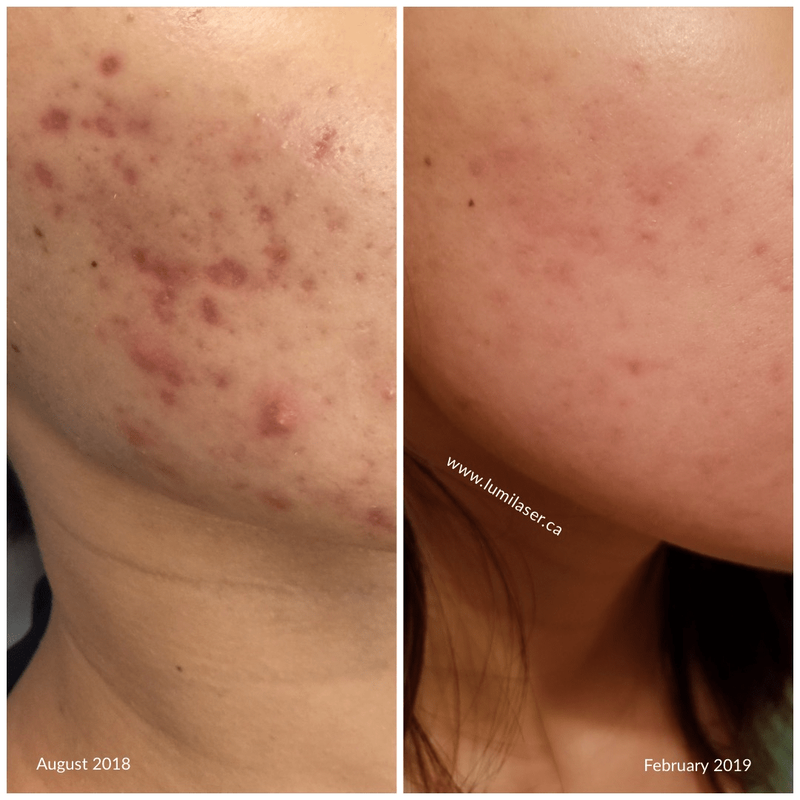 iS Clinical products in Canada, Montreal, Quebec, Acne, Acne Scars, Acne Marks treatments in Montreal, Laval, Quebec, Canada at Lumilaser - Eve Mamane