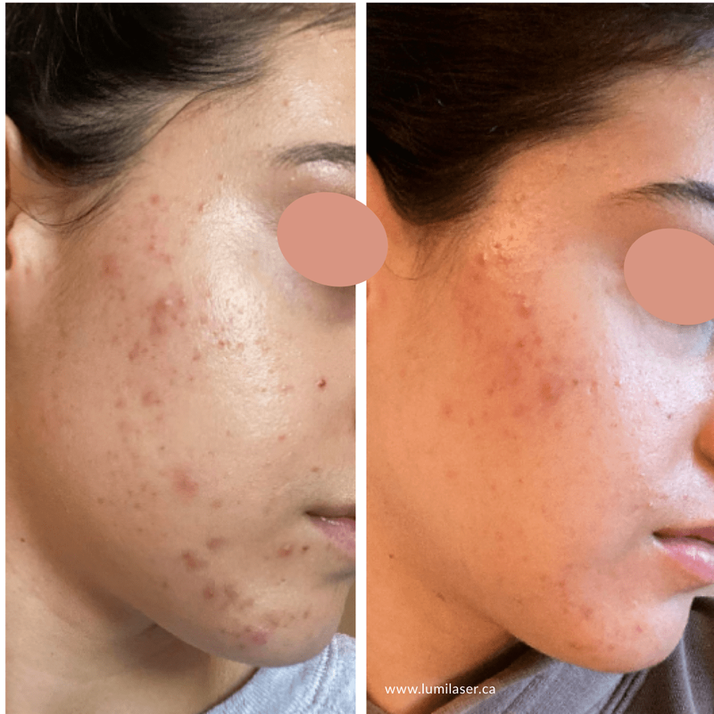 Acne products in Montreal, Canada, Acne Treatments Montreal, Acne Scars, Acne Marks at Lumilaser Montreal, Quebec, Canada