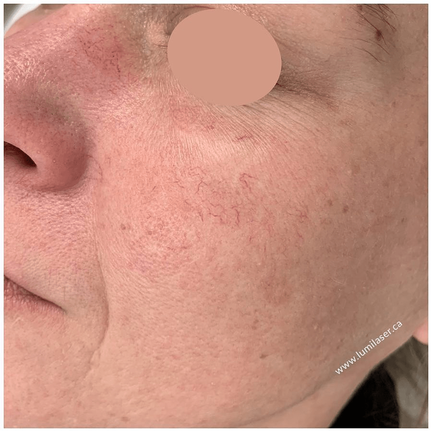 Treating Couperose with Laser in Montreal, Quebec, Canada, Facial Redness 