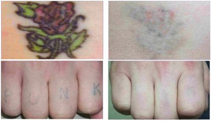 Laser tattoo removal in Montreal