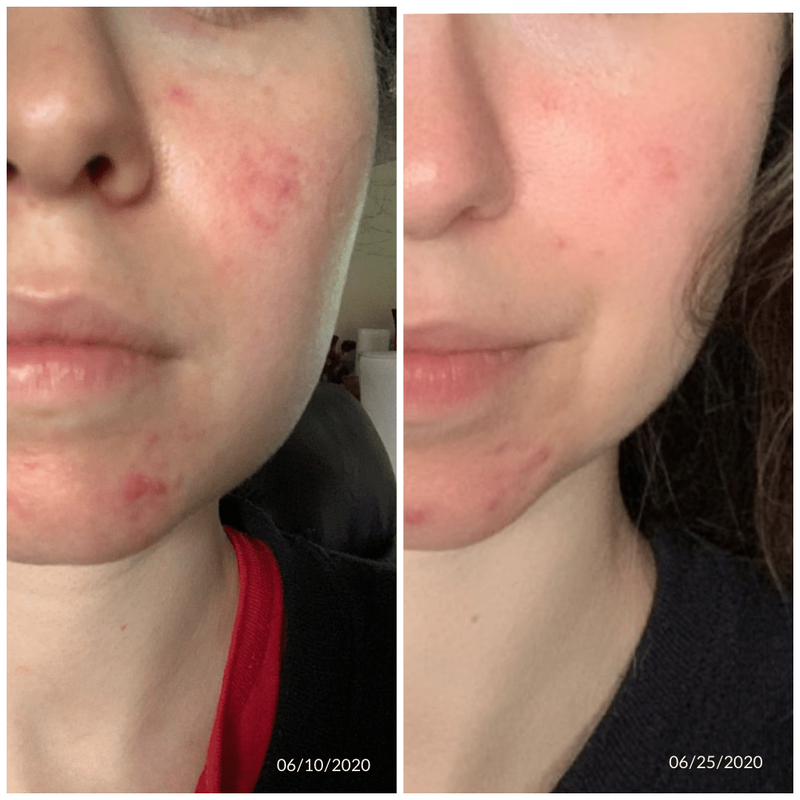 Teleskincare Lumilaser, acne skin, acne treatments in Montreal, Quebec, Canada. #TeleskincareCanada