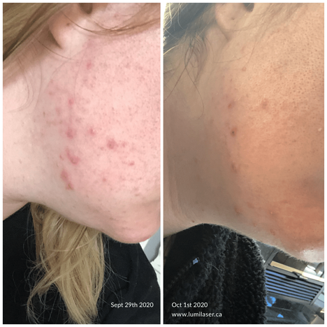 Meline Mask results before and after -  Lumilaser, Montreal, Quebec, Canada