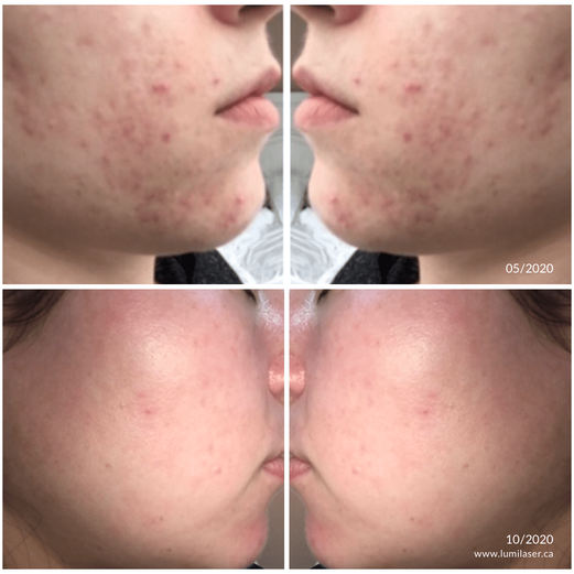 Acne results Lumilaser - Montreal, Quebec, Canada