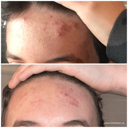 Lumilaser Acne Prone Skin Results, Teleskin, TeleSkincare, Montreal, Quebec, anada 