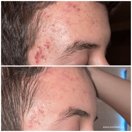 Lumilaser Acne Prone Skin Results, Teleskin, TeleSkincare, Montreal, Quebec, anada 