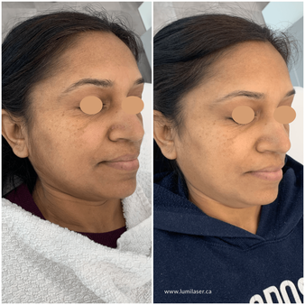 Luminous Glow Collection Is Clinical, Laser Skin Lightening, Laser Skin Brightening Treatments at Lumilaser Esthetics in Montreal, Laval, Quebec, Canada. Soins Laser Coup d’Éclat, Soins éclaircissants chez Lumilaser Esthetique, Montreal.