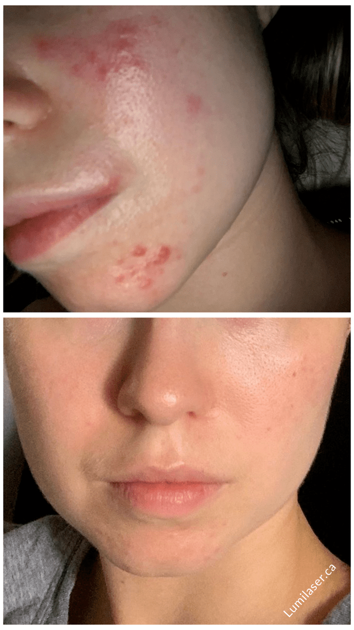 Teleskincare Lumilaser, acne skin, acne treatments in Montreal, Quebec, Canada. #TeleskincareCanada