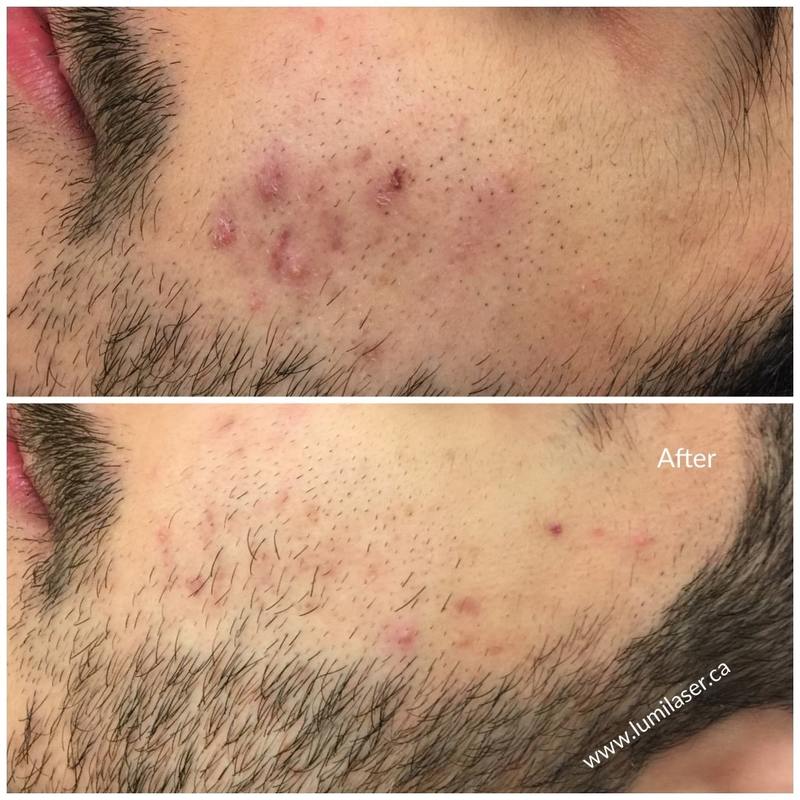 Laser Acne, Laser Acne Scars, Laser Acne Marks treatments in Montreal, Laval, Quebec, Canada at Lumilaser Esthetics by Eve Mamane, www.lumilaser.ca